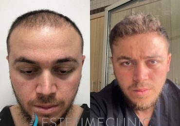 The DHI Hair Transplant Technique