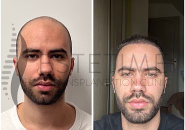 Why is Sapphire FUE Technique the Most Effective Method in Hair Transplantation?